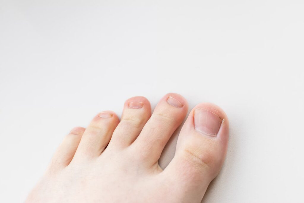 Toe Deformities converted